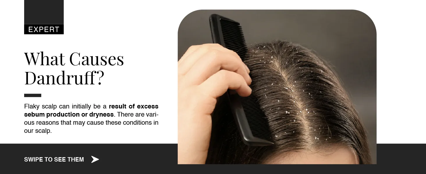 What Causes Dandruff?