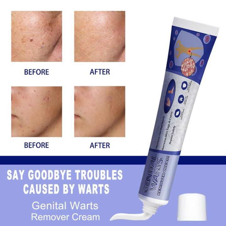 Relax%20day%20Skin%20Tag%20Wart%20Removal%20ubat%20buang%20ketuat%20kaki%20Wart%20Remover%20Cream%20Tag%20Solution%20Skin%20Tag%20Mole%20Buang%20Tahi%20Lalat%20Ketuat%20Kutil%20Traditional%20Natural%20Mole%20Ubat%20buang%20kutil%20ketuat%20tahi%20lalat%20biji%20kolestrol%20Traditional%20Mole%20Removal%20Pembuang%20Tahi%20Lalat%20Semu%20-%20Image%205