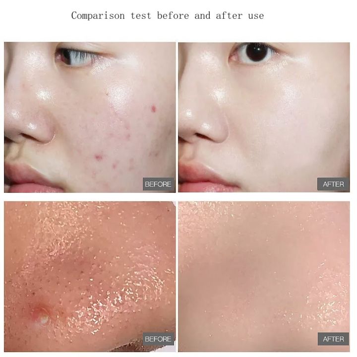 55%20pcs%20Soft%20Touch%20Pads%20Green%20Salicylic%20Acid%20Cotton%20Sheets%20Acne%20Repellent%20Shrink%20Pore%20Removal%20Blackhead%20Mask%20Salicylic%20acid%20cotton%20tablets%20-%20Image%202
