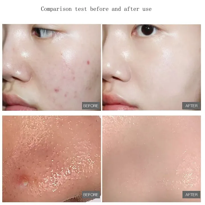 55%20pcs%20Soft%20Touch%20Pads%20Green%20Salicylic%20Acid%20Cotton%20Sheets%20Acne%20Repellent%20Shrink%20Pore%20Removal%20Blackhead%20Mask%20Salicylic%20acid%20cotton%20tablets%20-%20Image%202
