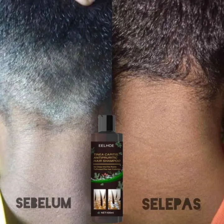 Relax%20night%20Hair%20Shampoo%20Shampoo%20kelemumur%20anti%20dandruff%20scalp%20treatment%20itchy%20scalp%20psoriasis%20syampoo%20oil%20control%20shampoo%20gatal%20kulit%20kepala%20%E9%A0%AD%E7%9A%AE%E5%B1%91%20%E6%B4%97%E7%99%BC%E6%B0%B4100ml%20-%20Image%203