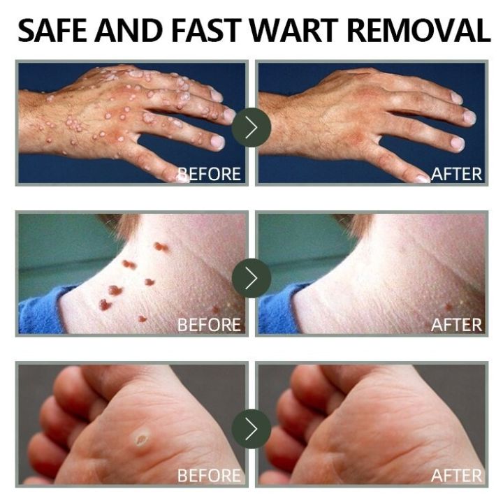 Relax%20day%20Skin%20Tag%20Wart%20Removal%20ubat%20buang%20ketuat%20kaki%20Wart%20Remover%20Cream%20Tag%20Solution%20Skin%20Tag%20Mole%20Buang%20Tahi%20Lalat%20Ketuat%20Kutil%20Traditional%20Natural%20Mole%20Ubat%20buang%20kutil%20ketuat%20tahi%20lalat%20biji%20kolestrol%20Traditional%20Mole%20Removal%20Pembuang%20Tahi%20Lalat%20Semu%20-%20Image%202
