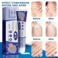 Relax day Skin Tag Wart Removal ubat buang ketuat kaki Wart Remover Cream Tag Solution Skin Tag Mole Buang Tahi Lalat Ketuat Kutil Traditional Natural Mole Ubat buang kutil ketuat tahi lalat biji kolestrol Traditional Mole Removal Pembuang Tahi Lalat Semu. 