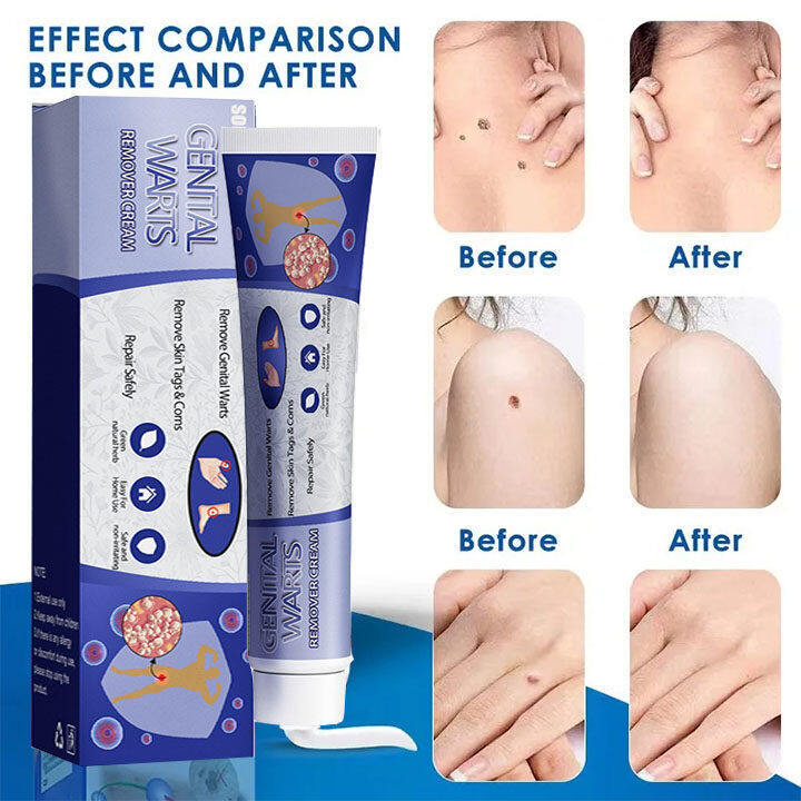 Relax%20day%20Skin%20Tag%20Wart%20Removal%20ubat%20buang%20ketuat%20kaki%20Wart%20Remover%20Cream%20Tag%20Solution%20Skin%20Tag%20Mole%20Buang%20Tahi%20Lalat%20Ketuat%20Kutil%20Traditional%20Natural%20Mole%20Ubat%20buang%20kutil%20ketuat%20tahi%20lalat%20biji%20kolestrol%20Traditional%20Mole%20Removal%20Pembuang%20Tahi%20Lalat%20Semu%20-%20Image%203