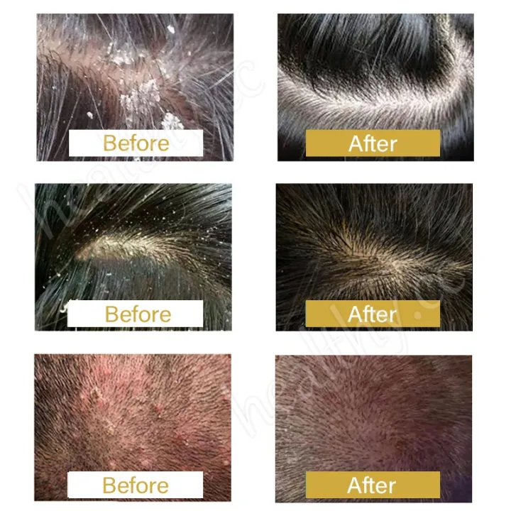 Relax%20night%20Hair%20Shampoo%20Shampoo%20kelemumur%20anti%20dandruff%20scalp%20treatment%20itchy%20scalp%20psoriasis%20syampoo%20oil%20control%20shampoo%20gatal%20kulit%20kepala%20%E9%A0%AD%E7%9A%AE%E5%B1%91%20%E6%B4%97%E7%99%BC%E6%B0%B4100ml%20-%20Image%205