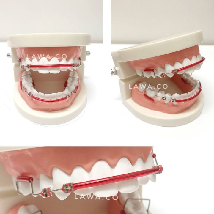 Thailook Braces Click Viral Sepasang | Atas Bawah