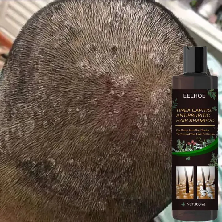 Relax%20night%20Hair%20Shampoo%20Shampoo%20kelemumur%20anti%20dandruff%20scalp%20treatment%20itchy%20scalp%20psoriasis%20syampoo%20oil%20control%20shampoo%20gatal%20kulit%20kepala%20%E9%A0%AD%E7%9A%AE%E5%B1%91%20%E6%B4%97%E7%99%BC%E6%B0%B4100ml%20-%20Image%202