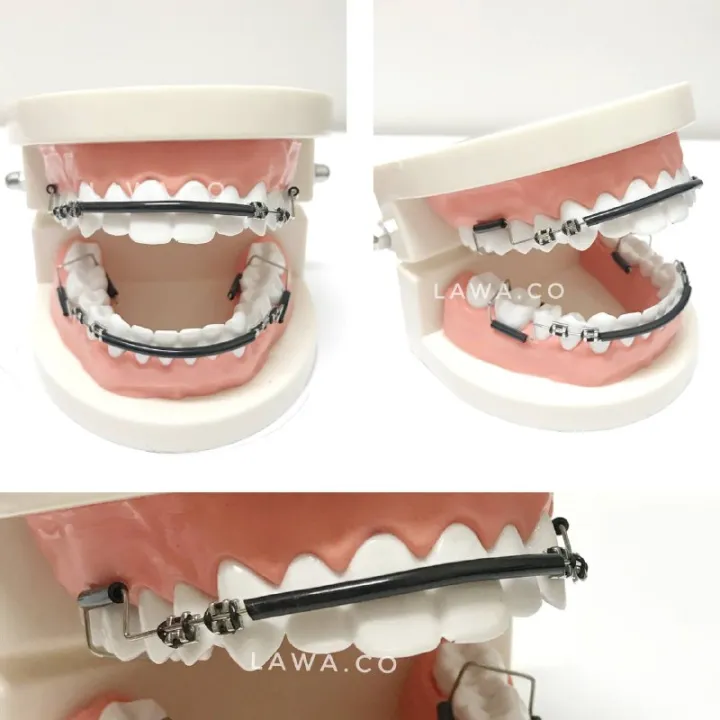 Thailook%20Braces%20Click%20Viral%20Sepasang%20%7C%20Atas%20Bawah%20-%20Image%202