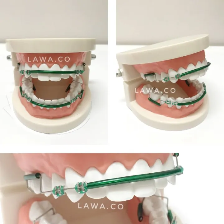 Thailook%20Braces%20Click%20Viral%20Sepasang%20%7C%20Atas%20Bawah%20-%20Image%203