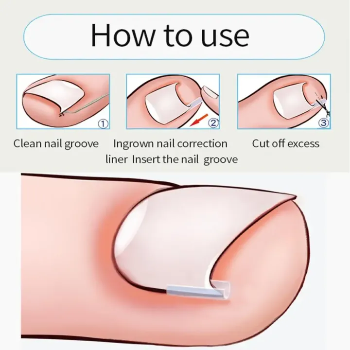 1-100PCS%20Ingrown%20Toenail%20Correction%20Ultra-thin%20Nail%20Treatment%20Elastic%20Patch%20Sticker%20Straightening%20Nails%20Groove%20Ingrown%20Corrector%20-%20Image%205