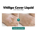 Vitiligo Cover Liquid Vitiligo Covering Liquid Waterproof Makeup Vitiligo Concealer Cosmetics for Face Body 20ml. 