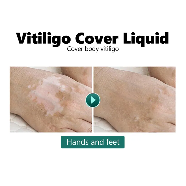 Vitiligo%20Cover%20Liquid%20Vitiligo%20Covering%20Liquid%20Waterproof%20Makeup%20Vitiligo%20Concealer%20Cosmetics%20for%20Face%20Body%2020ml%20-%20Image%205
