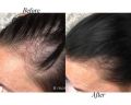 Onion Herbal Hair Oil 100ml By Vcare Best Hair Treatment Oil | Best Hair Fall Oil | Vitamin E blend Onion Oil. 