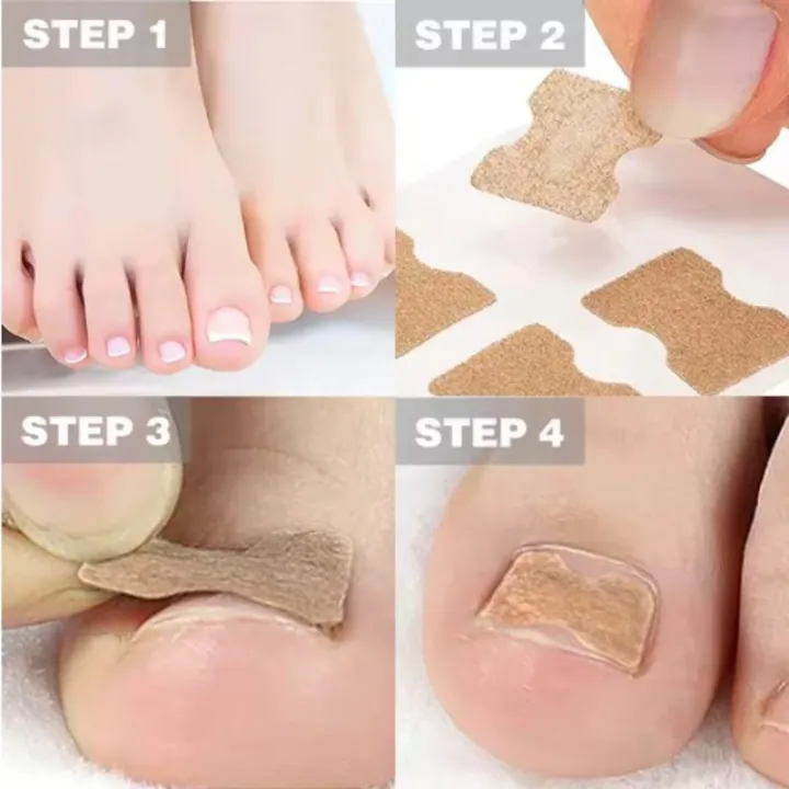 professional%20Nail%20Correction%20Stickers%20Ingrown%20Toenail%20Corrector%20Patches%20Paronychia%20Treatment%20Recover%20Corrector%20Pedicure%20Tools%20-%20Image%203