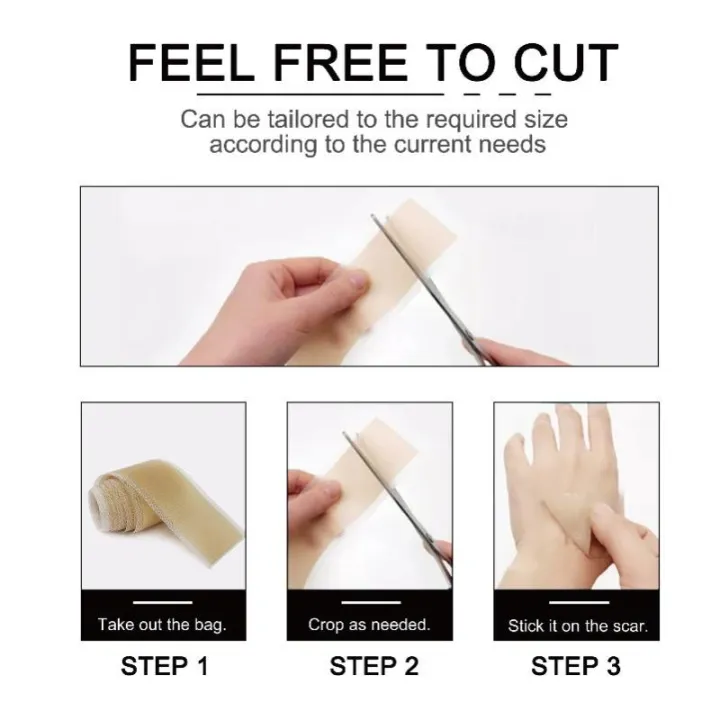 1%20Roll%20Silicone%20Gel%20Scar%20Sheet%20Patch%20Treatment%20Removal%20Tape%20Cover%20Burn%20Trauma%20Repair%20Acne%20Ear%20Scar%20Section%20Beauty%20Skin%20-%20Image%206