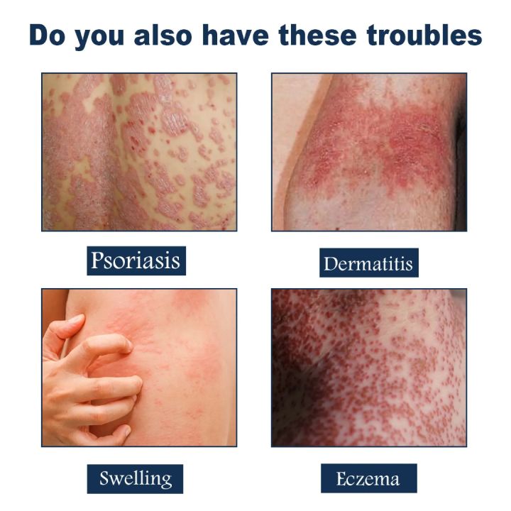 South%20Moon%20Psoriasis%20Relief%20Spray%20Net:%2030ml%20-%20Image%203