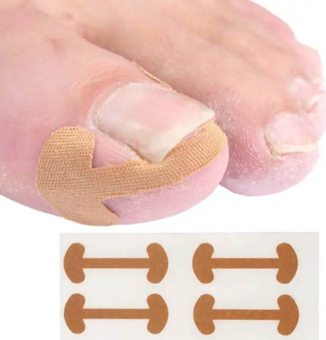 20-100pcs%20Adhesive%20Toenail%20Patch%20Ingrown%20Toe%20Nail%20Correction%20Sticker%20Foot%20Corrector%20Pedicure%20Health%20Care%20Tools%20Toe%20Treatment%20Pad%20freshfeet%20-%20Image%203