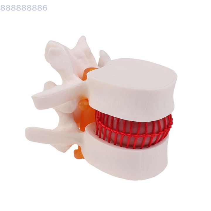 Enlarged Lumbar Spine Lumbar Disc Compression Demonstration Model Human ...