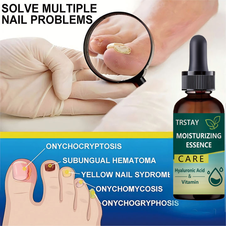 7DAYS%20Repair%20Nail%20Fungus%20Treatments%20Essence%20Foot%20Care%20Serum%20Toe%20Nails%20Fungal%20Removal%20Gel%20Anti-Infection%20freshfeet%20-%20Image%202