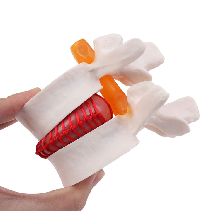 Enlarged Lumbar Spine Lumbar Disc Compression Demonstration Model Human ...