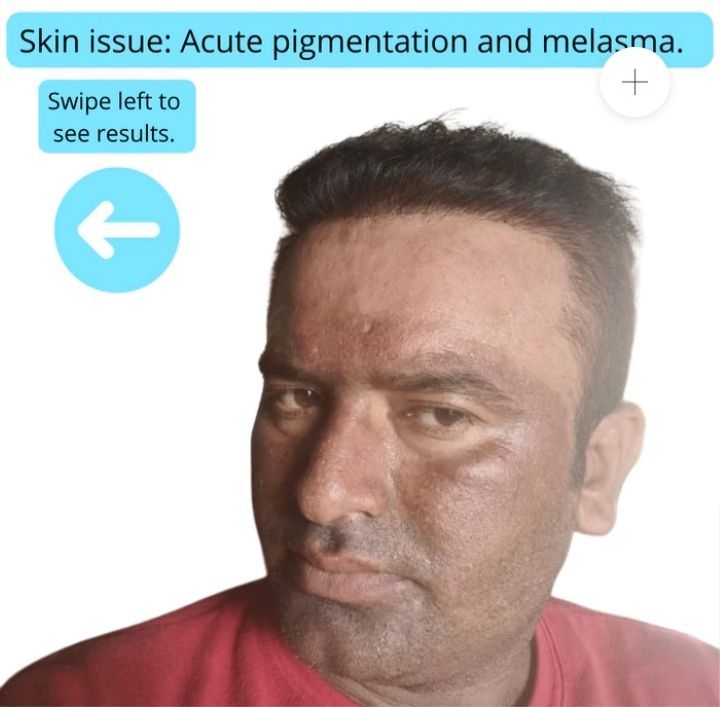 Nutra%20white%20Extreme%20Strong%20Whitening%20Kit%20Glutathione%20Cream%20&%20Serum%20-%20Image%204