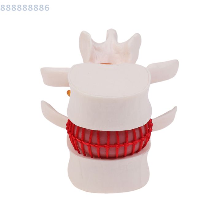 Enlarged Lumbar Spine Lumbar Disc Compression Demonstration Model Human ...