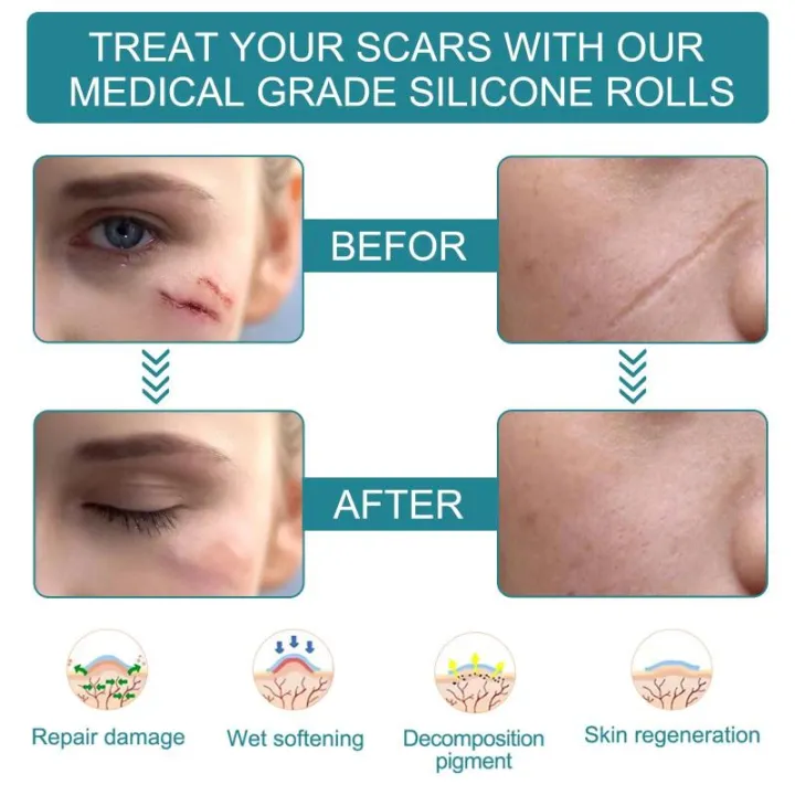 1%20Roll%20Silicone%20Gel%20Scar%20Sheet%20Patch%20Treatment%20Removal%20Tape%20Cover%20Burn%20Trauma%20Repair%20Acne%20Ear%20Scar%20Section%20Beauty%20Skin%20-%20Image%204