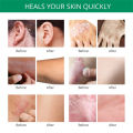 Jemeesen Psoriasis Medicated Treatment Cream. 
