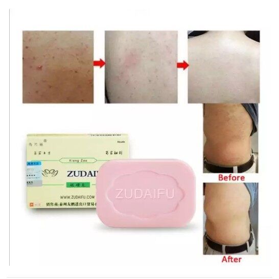 100%25%20Genuine%20Zudaifu%20Sulfur%20Soap,%20Natural%20Herbal%20Soap,%20Sulfur%20Soap,%20Skin%20Care,%20Bath%20Soap.%20%E2%80%8B%20%20%20Acne%20Care%20Soap%20%E2%80%8B%20%20%20Allergic%20%E2%80%8B%20Sweat%20Relieves%20Itching,%20Repairs%20and%20Moisturizes%2080%20Grams%20-%20Image%204