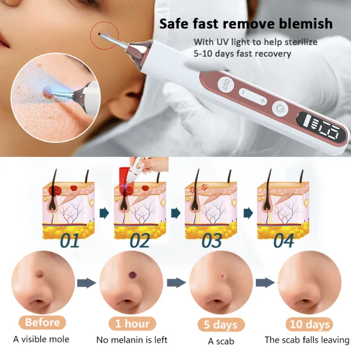 Plasma%20Pen%20Skin%20Tag%20Remover%20Mole%20Removal%20Wart%20Spots%20Dark%20Dpot%20Black%20Dot%20Nevus%20Freckle%20Flat%20Blemish%20Pimples%20Removal%20for%20Face%20Body%20-%20Image%205