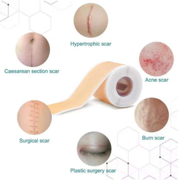 4cmx150cm%20Silicone%20Scar%20Sheets%20Removal%20Strips%20Silicone%20Gel%20Scar%20Strip%20For%20Acne%20Keloid%20Surgery%20Burn%20Treatment%20Scar%20Patch%20Hot%20Sale%20-%20Image%206