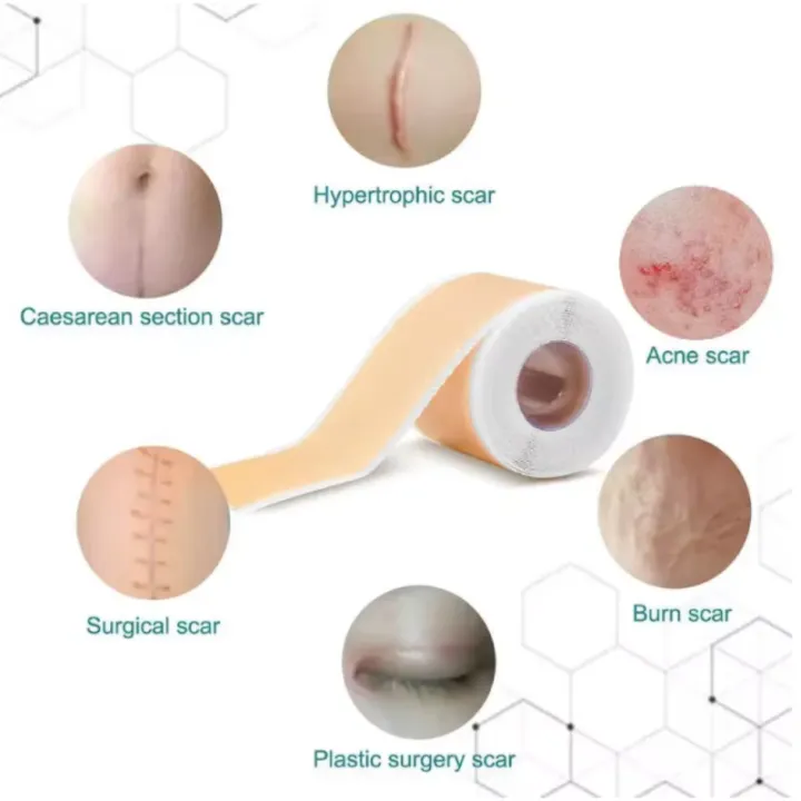 4cmx150cm%20Silicone%20Scar%20Sheets%20Removal%20Strips%20Silicone%20Gel%20Scar%20Strip%20For%20Acne%20Keloid%20Surgery%20Burn%20Treatment%20Scar%20Patch%20Hot%20Sale%20-%20Image%206