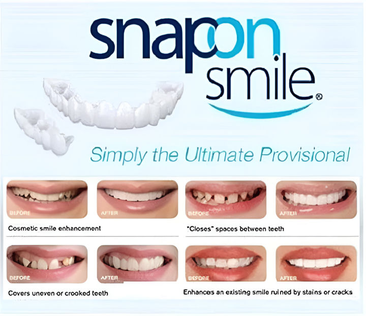 Snap-On Veneers for Instant Smile | Comfortable & Flexible Fit Temporary Dentures | Natural-Looking Cosmetic Teeth Covers for Upper & Lower Teeth | Easy Smile Makeover & Quick Transformation | Affordable Custom Fit Removable Teeth Veneers