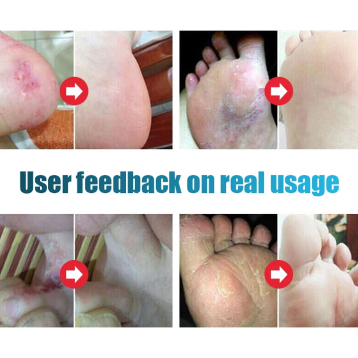 1Pcs%20Anti%20Fungal%20Foot%20Spray%20Foot%20Odor%20Remover%20Athlete%20Foot%20Medical%20Liquid%20Eczema%20Itching%20Onychomycosis%20Treatment%20Foot%20Care%20freshfeet%20-%20Image%205