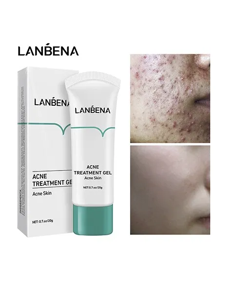 Authentic%20LANBENA%20Acne%20Treatment%20Gel%20-20g%20-%20Image%206