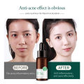 Laikou australia Tea tree Acne Treatment Brightening Moisturizing Oil-control anti-acne vitamin c serum-17ml. 