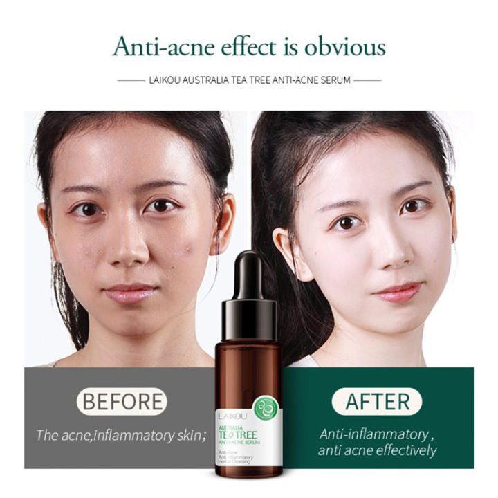 Laikou%20australia%20Tea%20tree%20Acne%20Treatment%20Brightening%20Moisturizing%20Oil-control%20anti-acne%20vitamin%20c%20serum-17ml%20-%20Image%202