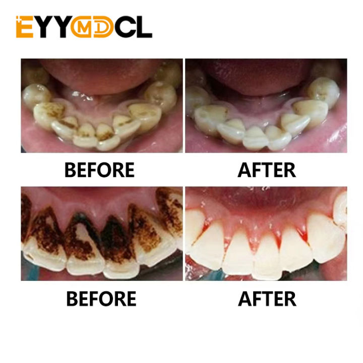 Oral%20Care%20Tooth%20Cleaning%20Tools%20Stainless%20Steel%20Dental%20Tools%20Oral%20Mirror%20Remover%20Tartar%20From%20Teeth%20Dentist%20Clinical%20Cleaning%20Kit%20-%20Image%206