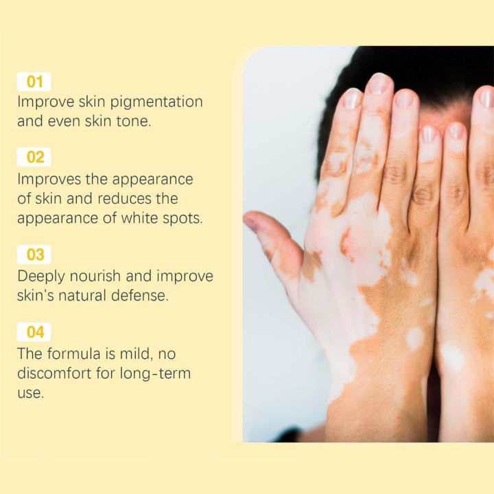 Original%20Vitigo%20Bee%20Venom%20Care%20Cream%20for%20Vitiligo,%20Pigmentation%20&%20White%20Spots%20%7C%20Skin%20Repair%20&%20Melanin%20Restoration%20Cream%20%7C%20Natural%20Herbal%20Treatment%20for%20Uneven%20Skin%20Tone%20%7C%20Moisturizing%20Anti-Spot%20Whitening%20Cream%20%E2%80%93%2020g%20%7C%20Gadget%20Xpres%20-%20Image%205