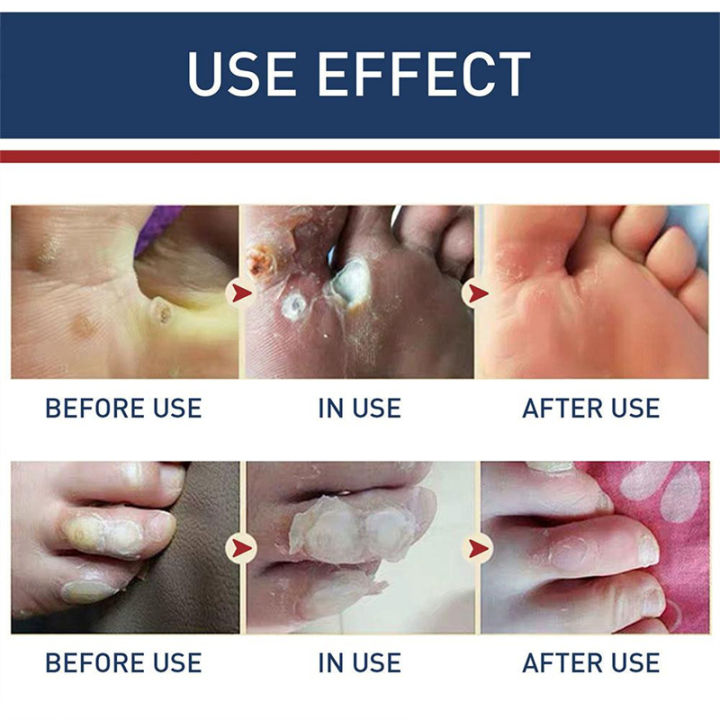 Dr.Jemeesen%20Corn%20Remover%20Pads%20for%20Feet%20Toes:%2030%20Pack%20Salicylic%20Acid%20Extra%20Strength%20Treatment%20-%20Fast%20Effective%20Medicated%20Bandages%20-%20Image%207