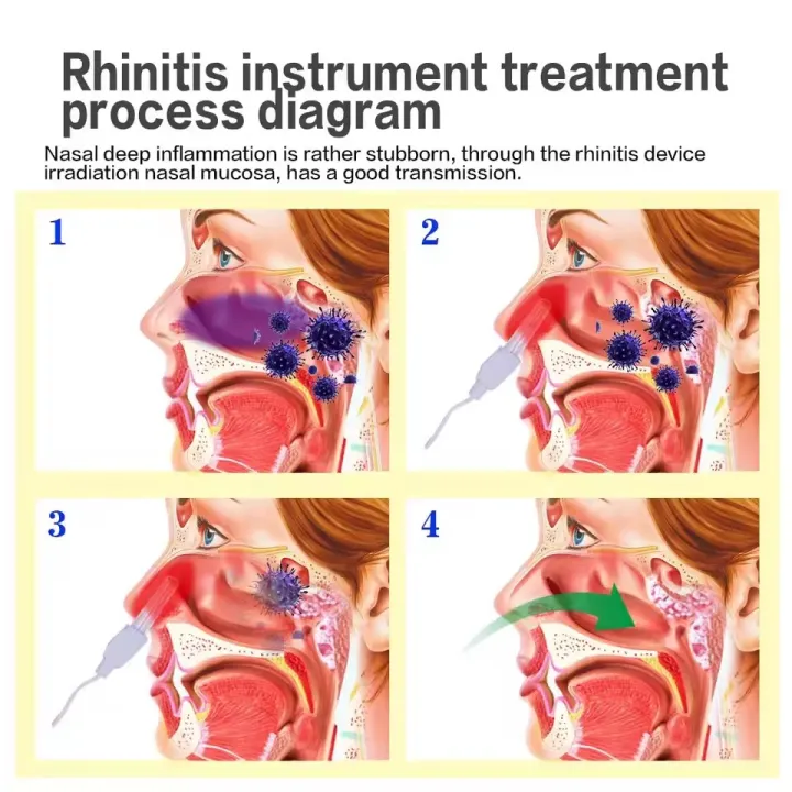 Nose%20Rhinitis%20Sinusitis%20Cure%20BioNase%20Laser%20Therapy%20Hay%20Fever%20Low%20Frequency%20Pulse%20Nose%20Massage%20Runny%20Sneeze%20Treatment%20Machine%20-%20Image%202
