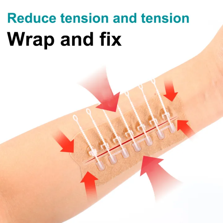 Closure Patch Zipper Tie Wound Closure Patch Hemostatic Patch Wound Fast Without ...