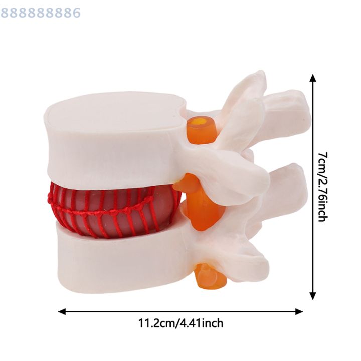 Enlarged Lumbar Spine Lumbar Disc Compression Demonstration Model Human ...
