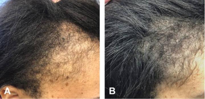 Minoxidil%205%25%20Hair%20Topical%20Solution%20Hairfall%20Solution%20Hair%20Regrowth%20-%20Minoxin%20spray%20-%20Image%208
