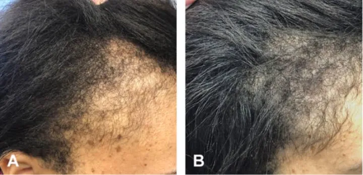 Minoxidil%205%25%20Hair%20Topical%20Solution%20Hairfall%20Solution%20Hair%20Regrowth%20-%20Minoxin%20spray%20-%20Image%208