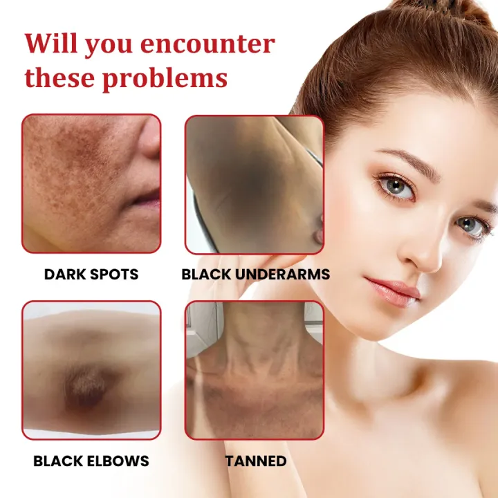 Ouhoe%20Dark%20Spot%20Cream%2030ml%20-%20Image%203