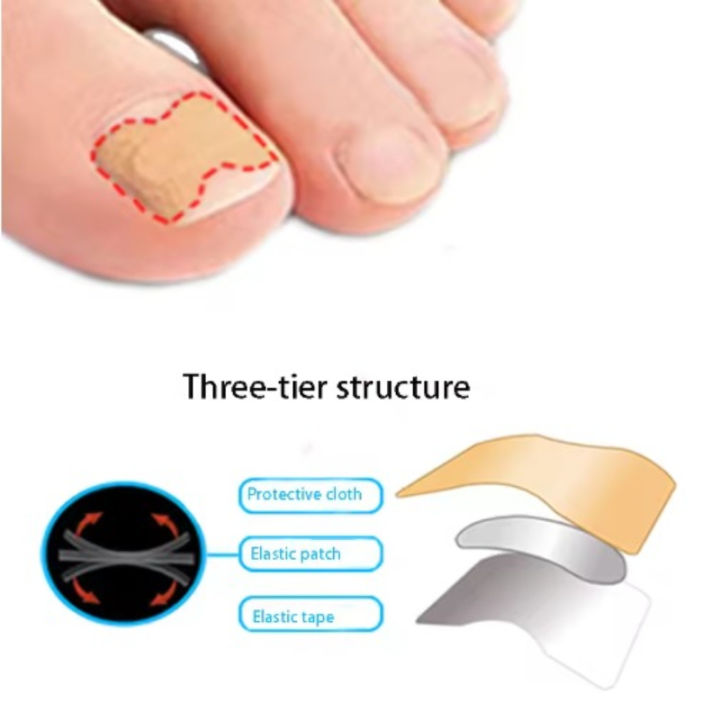 professional%20Nail%20Correction%20Stickers%20Ingrown%20Toenail%20Corrector%20Patches%20Paronychia%20Treatment%20Recover%20Corrector%20Pedicure%20Tools%20-%20Image%204