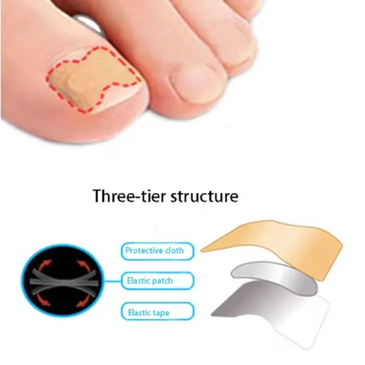 professional%20Nail%20Correction%20Stickers%20Ingrown%20Toenail%20Corrector%20Patches%20Paronychia%20Treatment%20Recover%20Corrector%20Pedicure%20Tools%20-%20Image%204