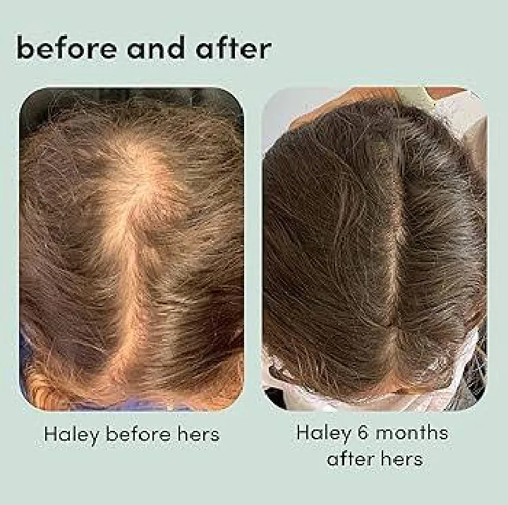 Minoxin%20Plus%20Topical%20Hair%20Regrowth%20Solution%20(Minoxidil%205%25),%2060ml%20-%20Brookes%20Pharma%20-%20Image%206