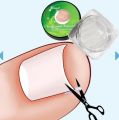 1-100PCS Ingrown Toenail Correction Ultra-thin Nail Treatment Elastic Patch Sticker Straightening Nails Groove Ingrown Corrector.